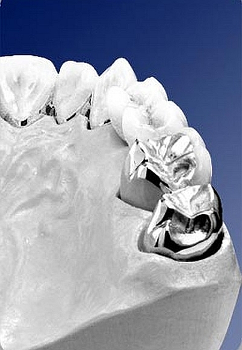 protese dentária com paládio